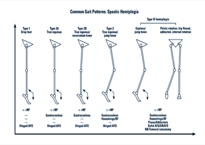 Ненормальные модели походки у детей с гемиплегией